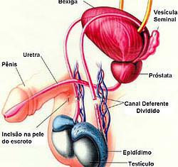 vasectomia