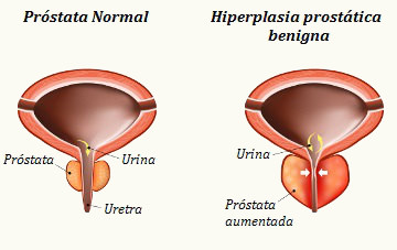 Hiperplasia Prostática Benigna